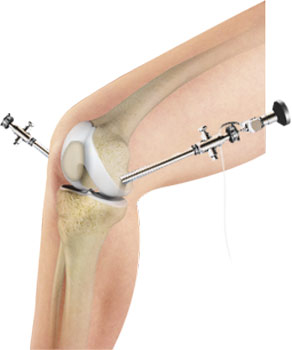 arthroscopy-of-the-knee-joint