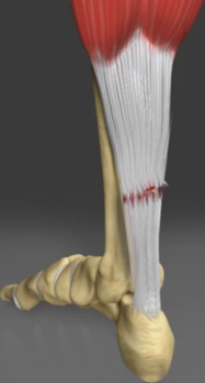 Achilles Tendon Rupture