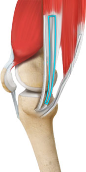 acl-reconstruction-hamstring-tendon