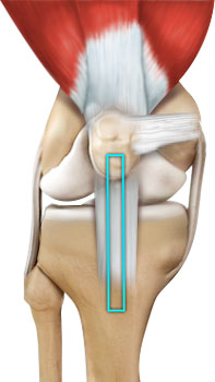 acl-reconstruction-patellar-tendon