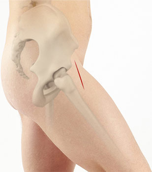 anterior-hip-replace