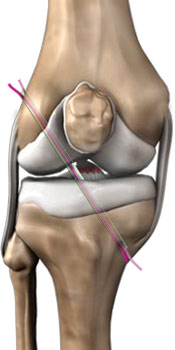 anterior-ruciate-ligament-reconstruction