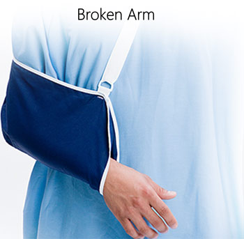 Broken Arm