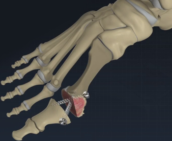 bunion-surgery