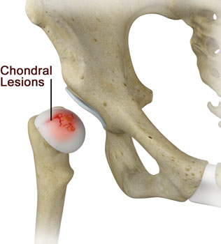 Chondral Lesions or Injuries 