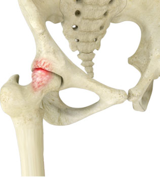 Femoral Acetabular Impingement Surgery