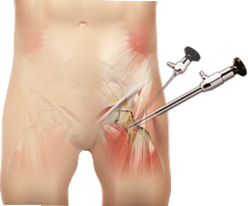 hip-arthroscopy