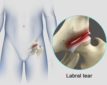 Hip Labral Tear