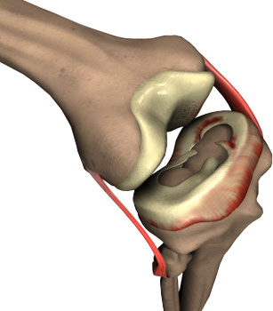 Meniscus Tear