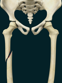 Pediatric Thighbone