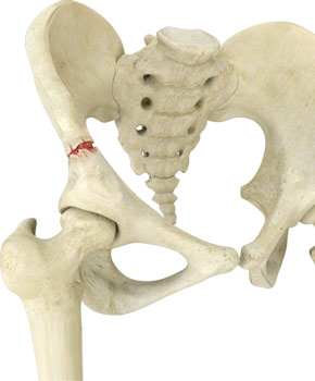 What physical therapy techniques are used for pelvic fractures?