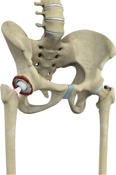 revision-hip-replacement
