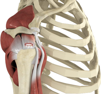 rotator cuff tear