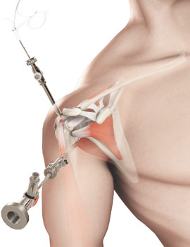 Shoulder Arthroscopy