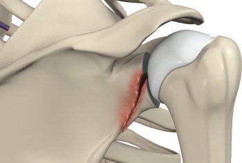 shoulder-fracture
