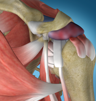 Shoulder Impingement Treatment Perth | Arthroscopy Surgery Perth WA