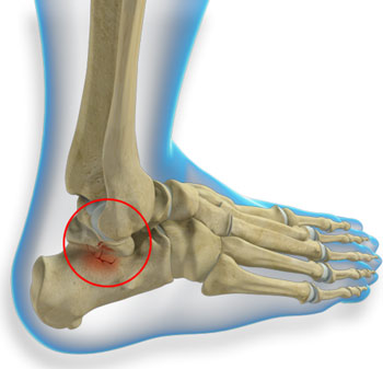 Talus Fracture Treatment Perth| Ankle Joint Fracture Surgery Perth