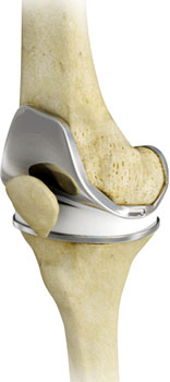 total-knee-replacement